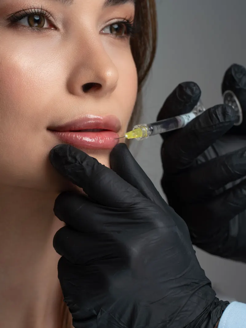Imagem ilustrativa da aplicação de preenchedor labial com seringa por profissional