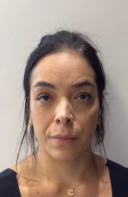 Antes — Harmonização facial