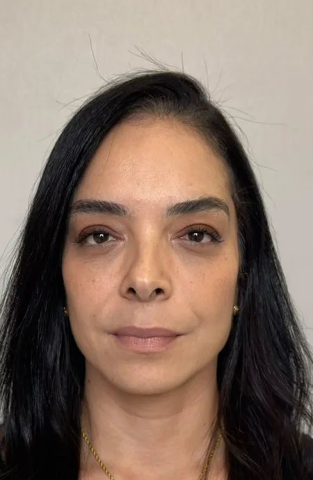 Depois — Harmonização facial