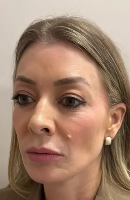 Antes — Harmonização facial