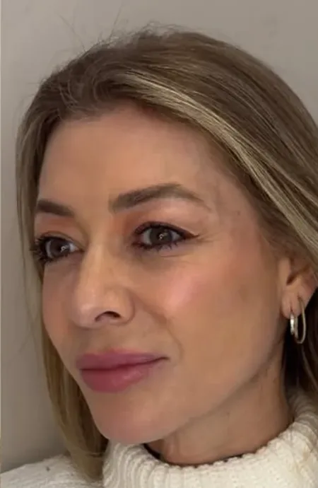 Depois — Harmonização facial