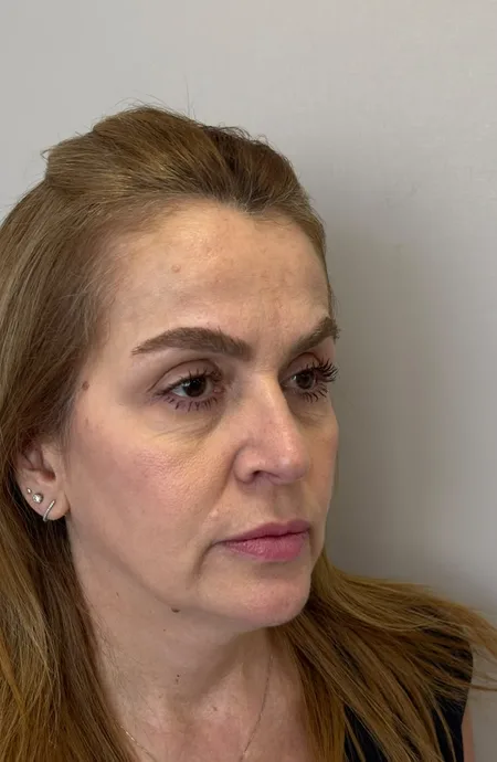Antes — Harmonização facial