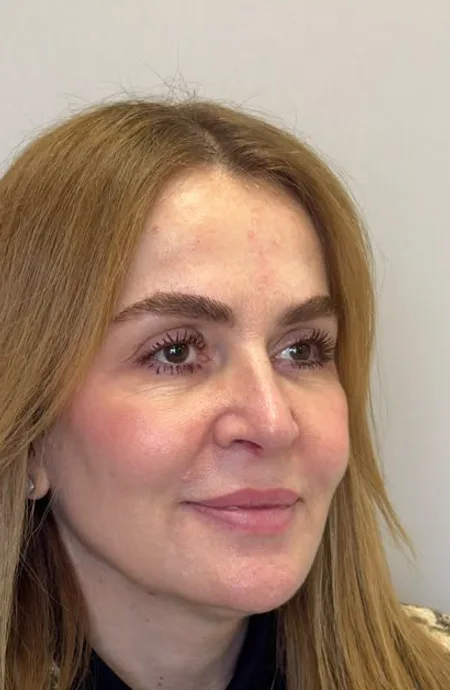 Depois — Harmonização facial