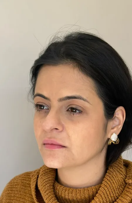 Antes — Harmonização facial