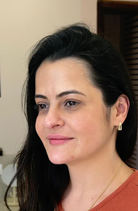Depois — Harmonização facial